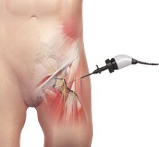 Hip Arthroscopy