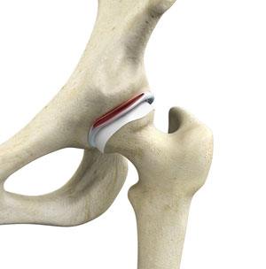 Hip Ligament Injuries