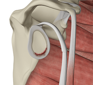 Shoulder Instability