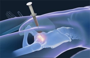 Orthobiologics for the Hip