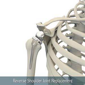 Reverse total shoulder replacement