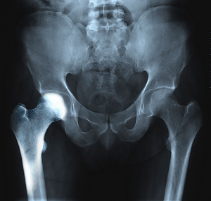 Transient Osteoporosis of the Hip