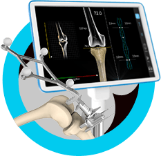 Computer Assisted Knee Replacement