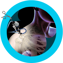 Shoulder Arthroscopy